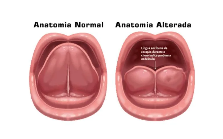 Ilustração comparando a anatomia normal da língua com a anatomia alterada pelo frênulo curto